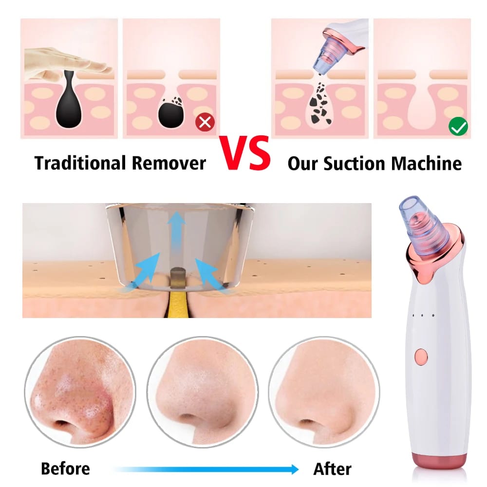 Original 5-in-1 Blackhead remover 🤩 | Multi-Functional | With Rechargeable 🔋